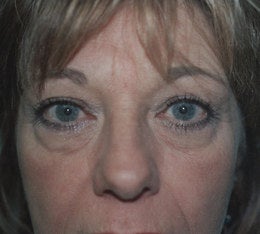 56 year old female patient before 665115