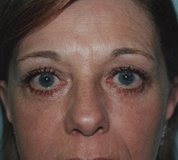 56 year old female patient after 665115