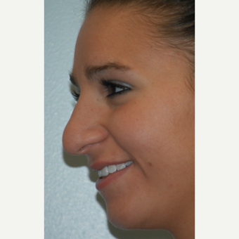 18-24 year old woman treated with Rhinoplasty before 3621254