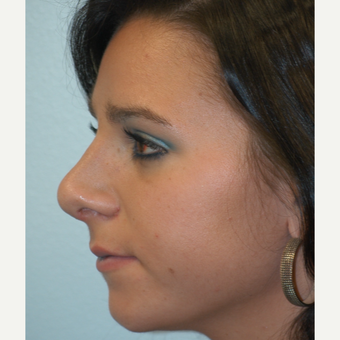 18-24 year old woman treated with Rhinoplasty after 3621254