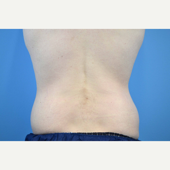 25-34 year old man treated with Body Lift before 3280613