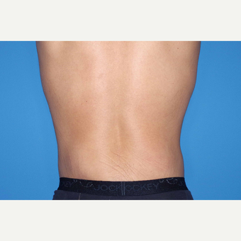 25-34 year old man treated with Body Lift after 3280613