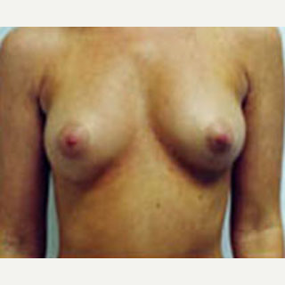 18-24 year old woman treated with Breast Augmentation before 3788574