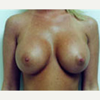 18-24 year old woman treated with Breast Augmentation after 3788574