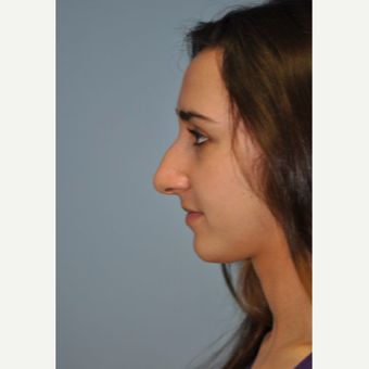 18-24 year old woman treated with Rhinoplasty before 3332356