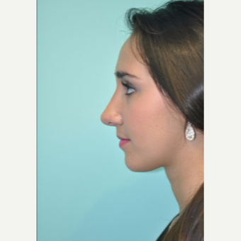 18-24 year old woman treated with Rhinoplasty after 3332356