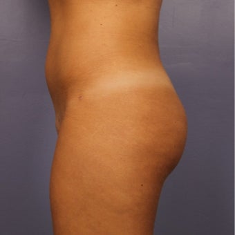 Brazilian Butt Lift, early 20s after 2593640