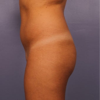 Brazilian Butt Lift, early 20s before 2593640