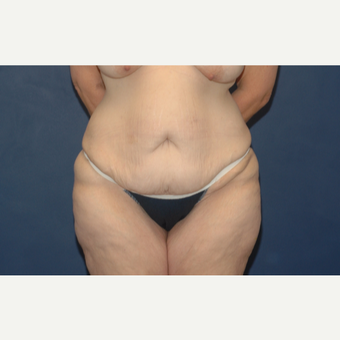 54 year old woman treated with Tummy Tuck before 3283150