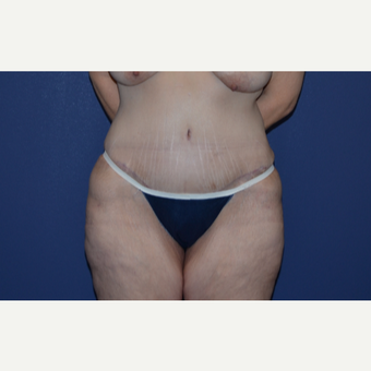 54 year old woman treated with Tummy Tuck after 3283150