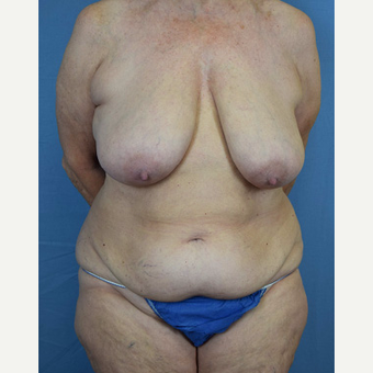 55-64 year old woman treated with Mommy Makeover before 3589270