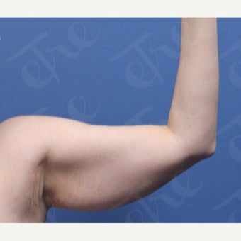45-54 year old woman treated with Laser Liposuction before 2526343