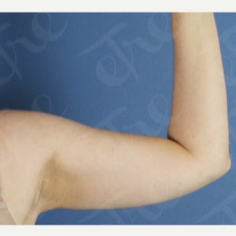 45-54 year old woman treated with Laser Liposuction after 2526343
