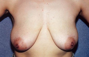 Breast Lift with Implants - 29 year old female, 5'2", 125 lbs before 1235278