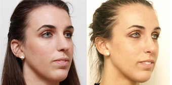 Septoplasty with rhinoplasty after 619694