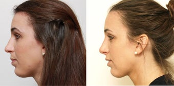 Septoplasty with rhinoplasty 619694