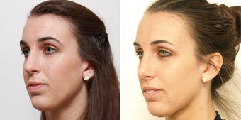 Septoplasty with rhinoplasty 619694