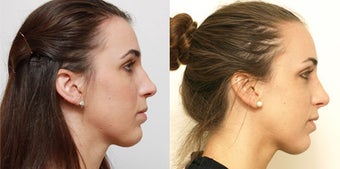 Septoplasty with rhinoplasty before 619694
