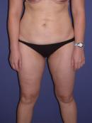 Thigh Lift before 329951