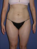 Thigh Lift 329951