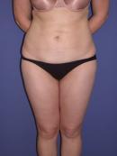 Thigh Lift 329951