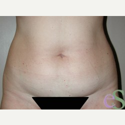 42 year old woman treated with Tummy Tuck before 3484922