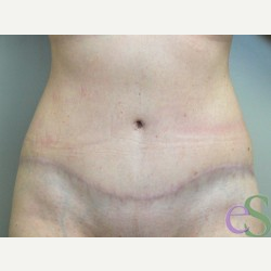 42 year old woman treated with Tummy Tuck after 3484922