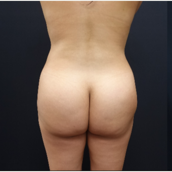 25-34 year old woman treated with Brazilian Butt Lift before 3286151