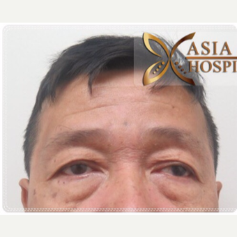 55-64 year old man treated with Eye Bags Treatment before 3761032