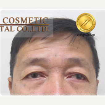 55-64 year old man treated with Eye Bags Treatment after 3761032