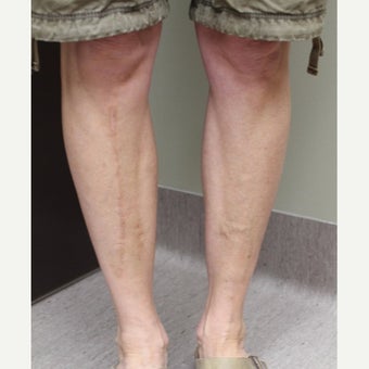 45-54 year old woman treated with Sclerotherapy after 2081487