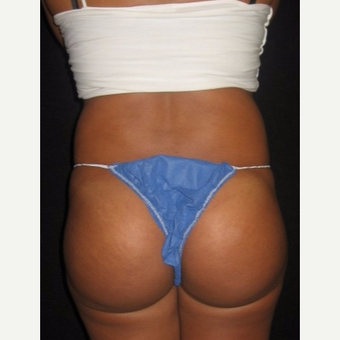 25-34 year old woman treated with Brazilian Butt Lift after 3064628