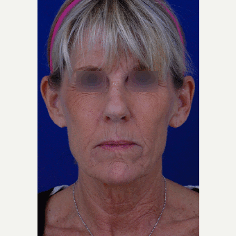 55-64 year old woman treated with Facelift 1850688