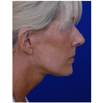 55-64 year old woman treated with Facelift after 1850688