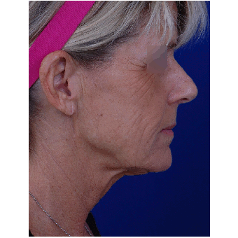 55-64 year old woman treated with Facelift before 1850688