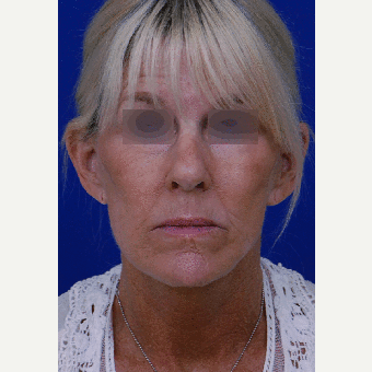 55-64 year old woman treated with Facelift 1850688