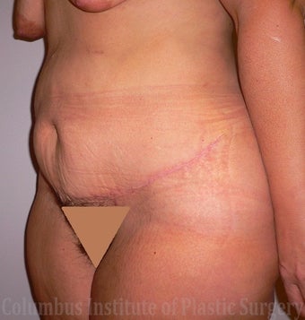 43 Year Old Woman has Panniculectomy after 1248547