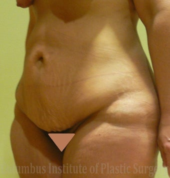 43 Year Old Woman has Panniculectomy before 1248547