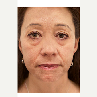45-54 year old woman treated with Eyelid Surgery before 3548888