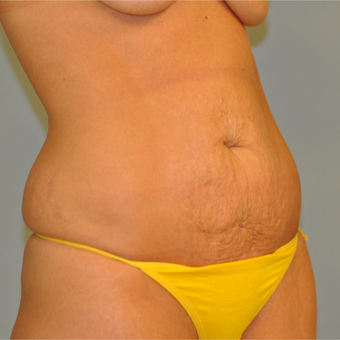 25-34 year old woman treated with Drainless Tummy Tuck before 3143572