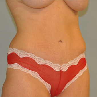 25-34 year old woman treated with Drainless Tummy Tuck after 3143572