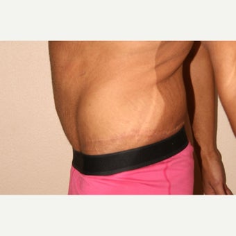 25-34 year old man treated with Male Tummy Tuck after 2490841