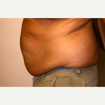 25-34 year old man treated with Male Tummy Tuck before 2490841