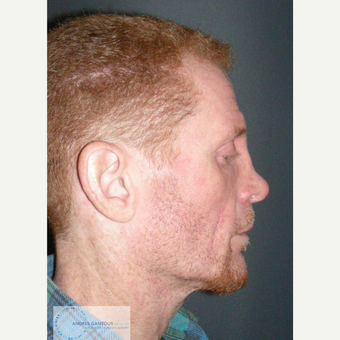 35-44 year old man treated with Rhinoplasty before 3692064