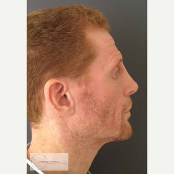 35-44 year old man treated with Rhinoplasty after 3692064