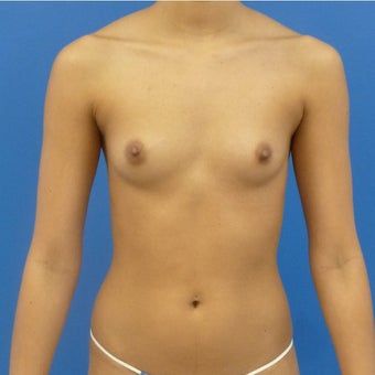 18-24 year old woman treated with Breast Augmentation before 1673456
