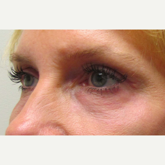 Eye Bags Treatment for This 48 Year Old Woman after 3305535