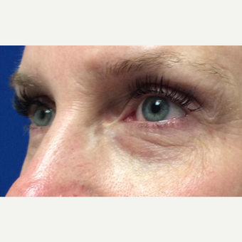 Eye Bags Treatment for This 48 Year Old Woman before 3305535