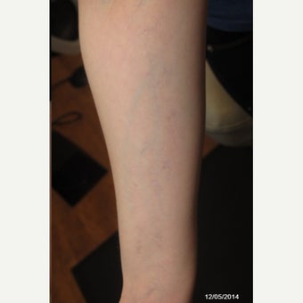 25-34 year old woman treated with PicoSure after 1672395