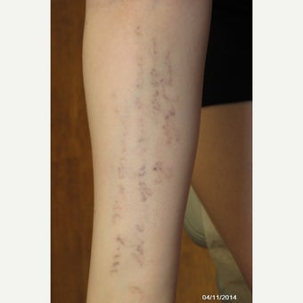 25-34 year old woman treated with PicoSure before 1672395